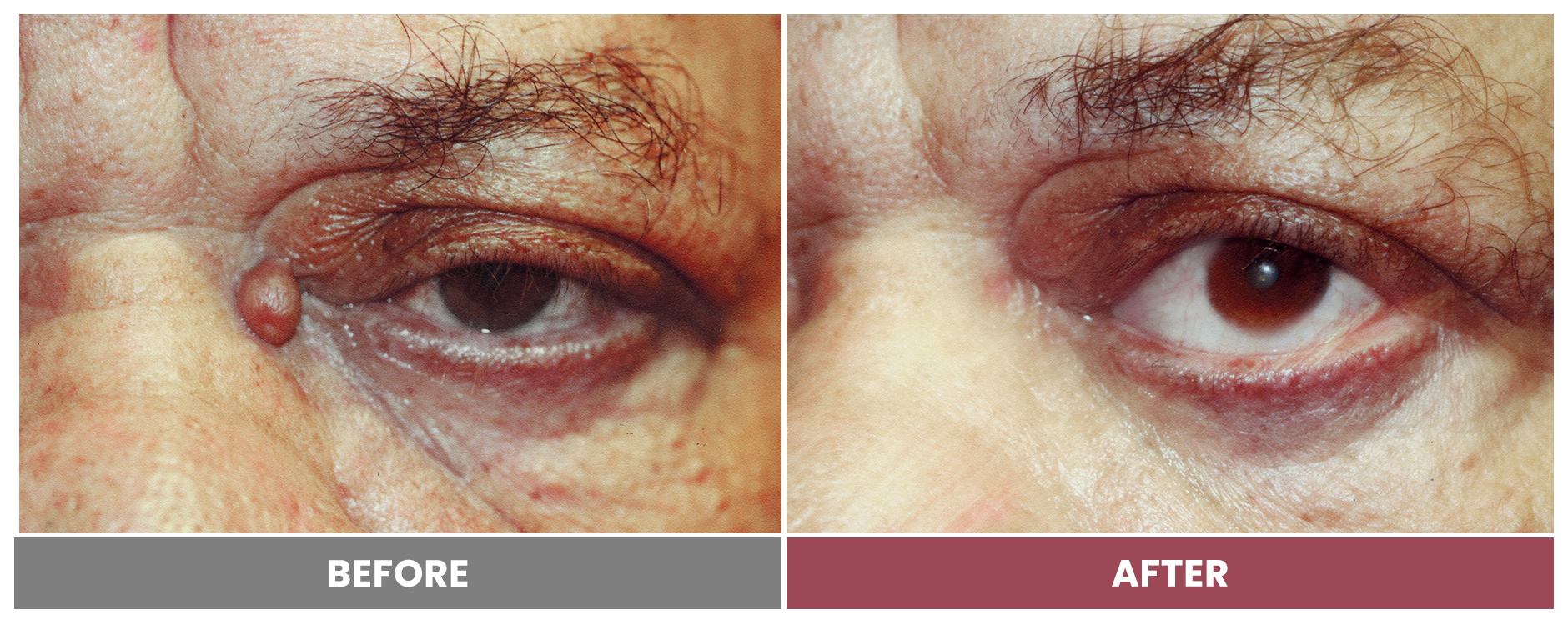 TUMOR REMOVAL AND RECONSTRUCTION - Case 14